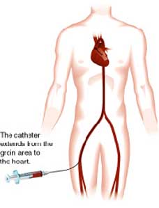 Route of Cardiac Catheterization